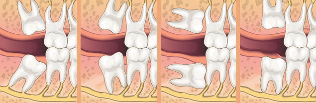 Types of impacted wisdom teeth diagram
